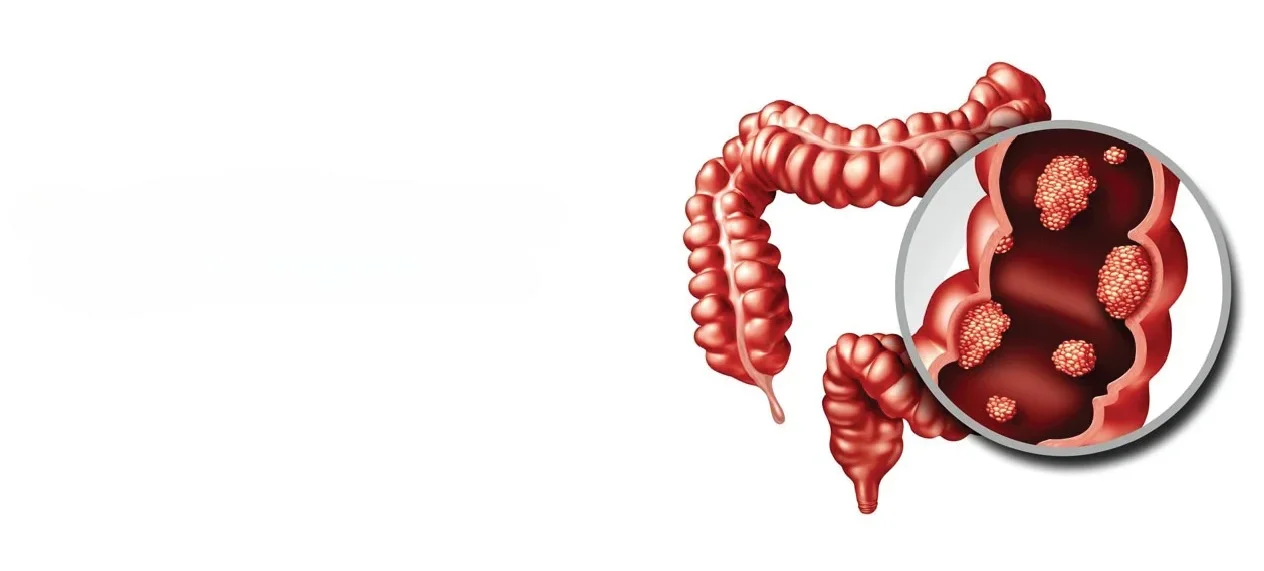 Potential causes and Risk Factors of Colon Cancer